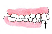 Excessive Protrusion of the Upper Front Teeth